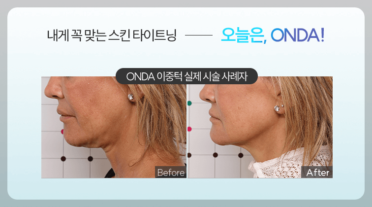 온다 리프팅