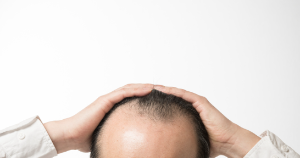 남성형 탈모증(AGA)이란