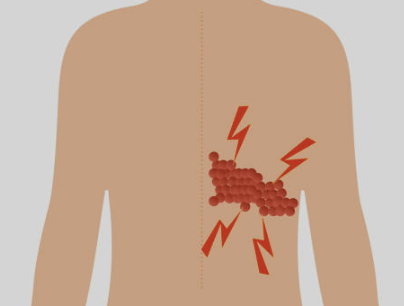 대상포진 예방접종 가격(최저가) 초기증상 치료방법 총정리