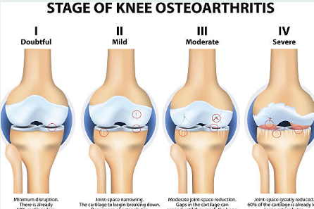 류마티스 관절염