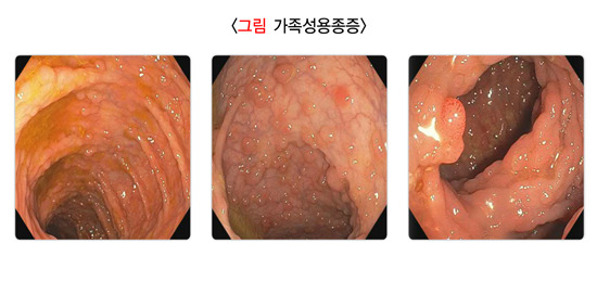 가족성용종, 대장내시경, 대장 폴립(용종)