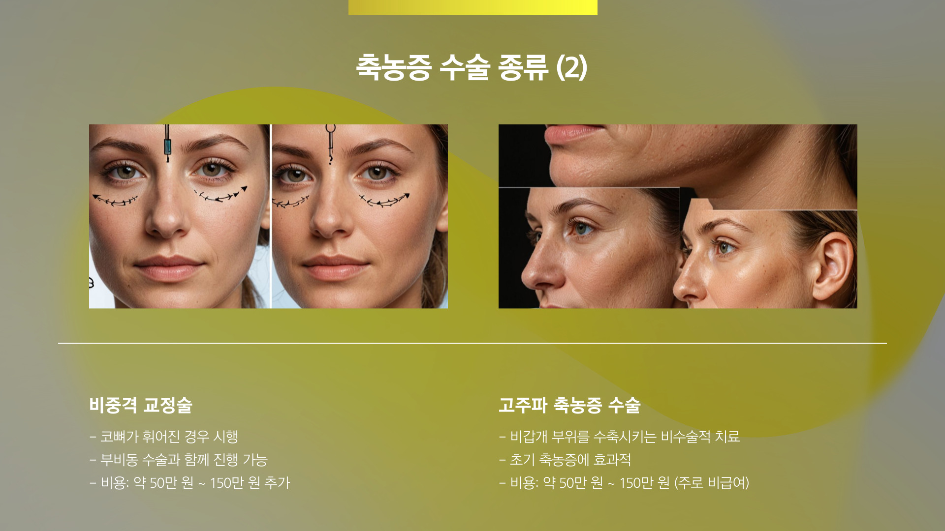 축농증 수술 비용