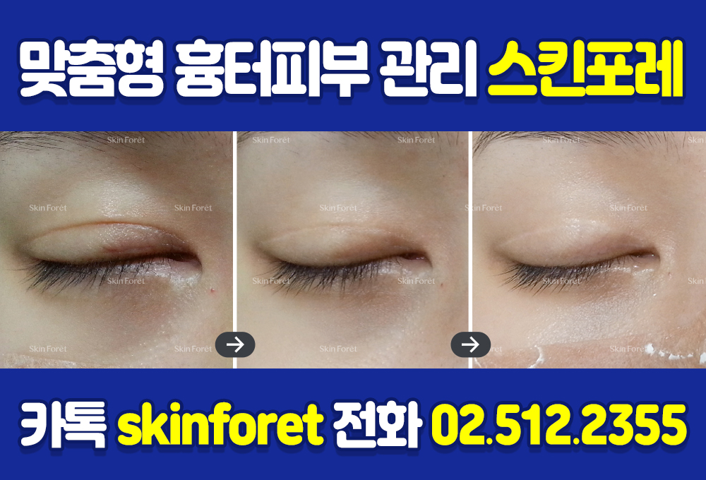 레이저·주사 없이 절개 흉터를 케어하는 방법, 스킨포레 과정 사진