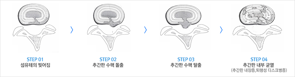 허리디스크 증상 허리디스크에 좋은 운동 다리저림 자가진단 치료법