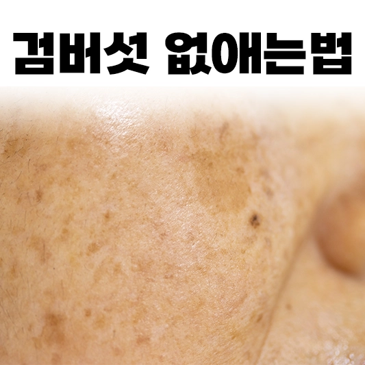 검버섯&#44;섬네일&#44;얼굴