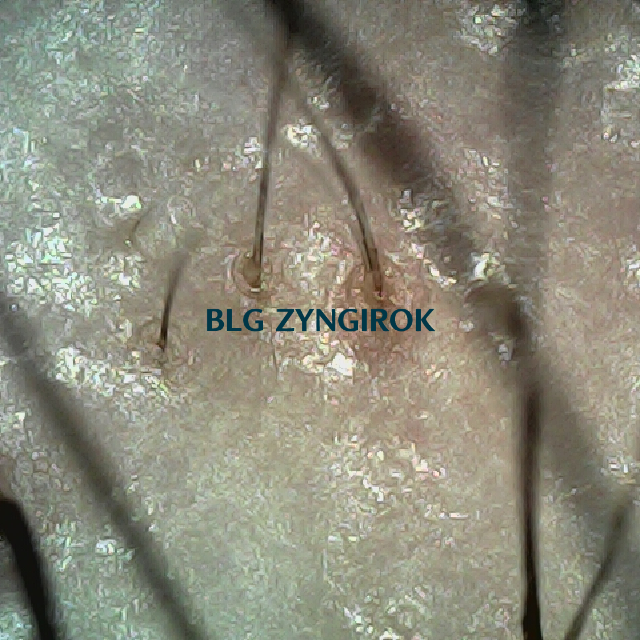 피나모아 복용 11주차 두피사진 - 오른쪽 M자 부위 모습이다.