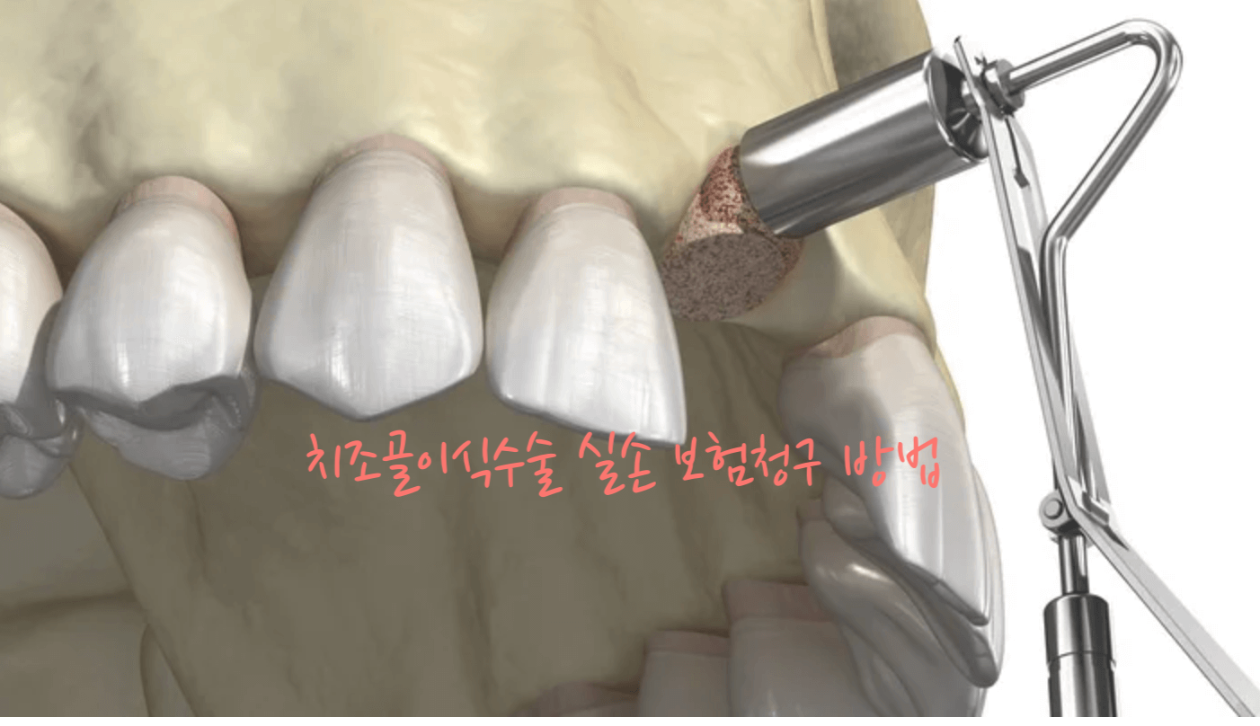 치조골이식수술
