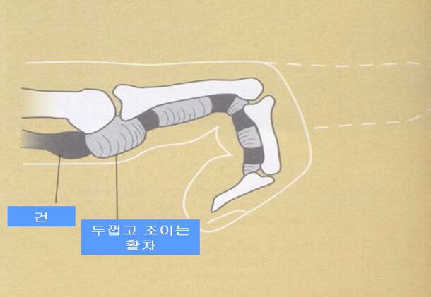 방아쇠수지증후군-건-활차