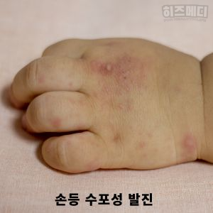 수족구 증상
