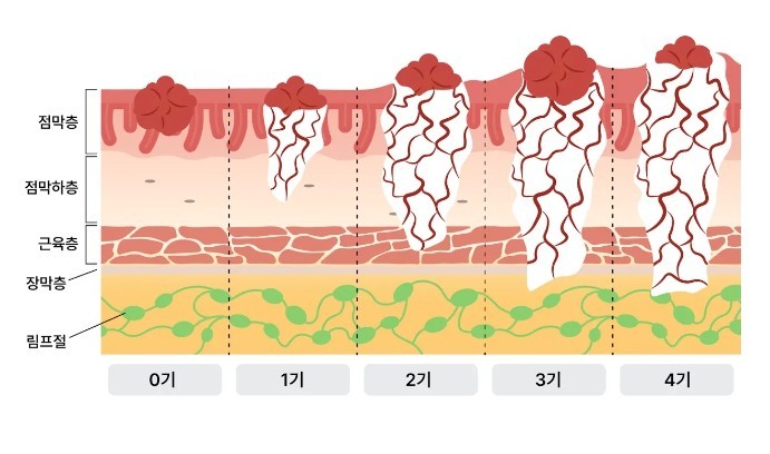 대장암 진행단계 이미지