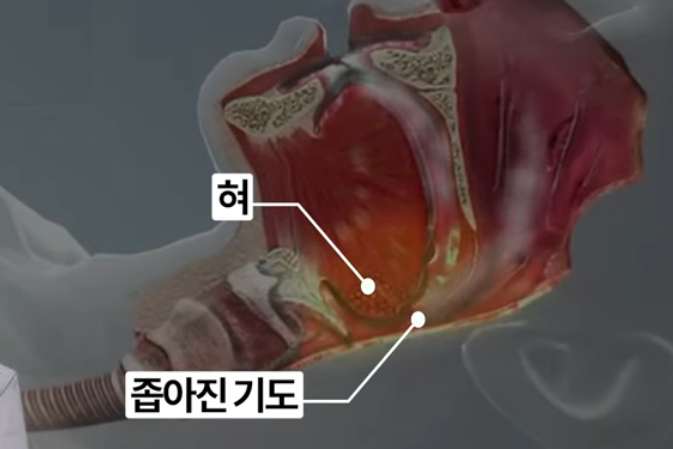 코골이의 원인 설명 좁아진 기도