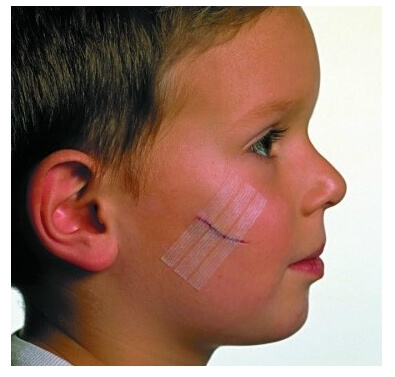 스테리스트립사용법