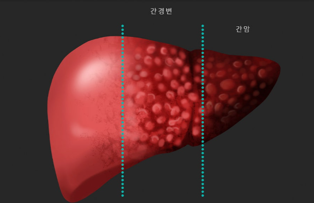 간암의 종류