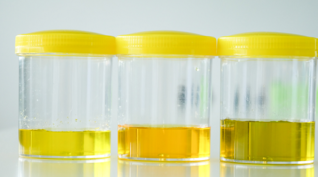 소변 색깔이 짙은 노란색일 때