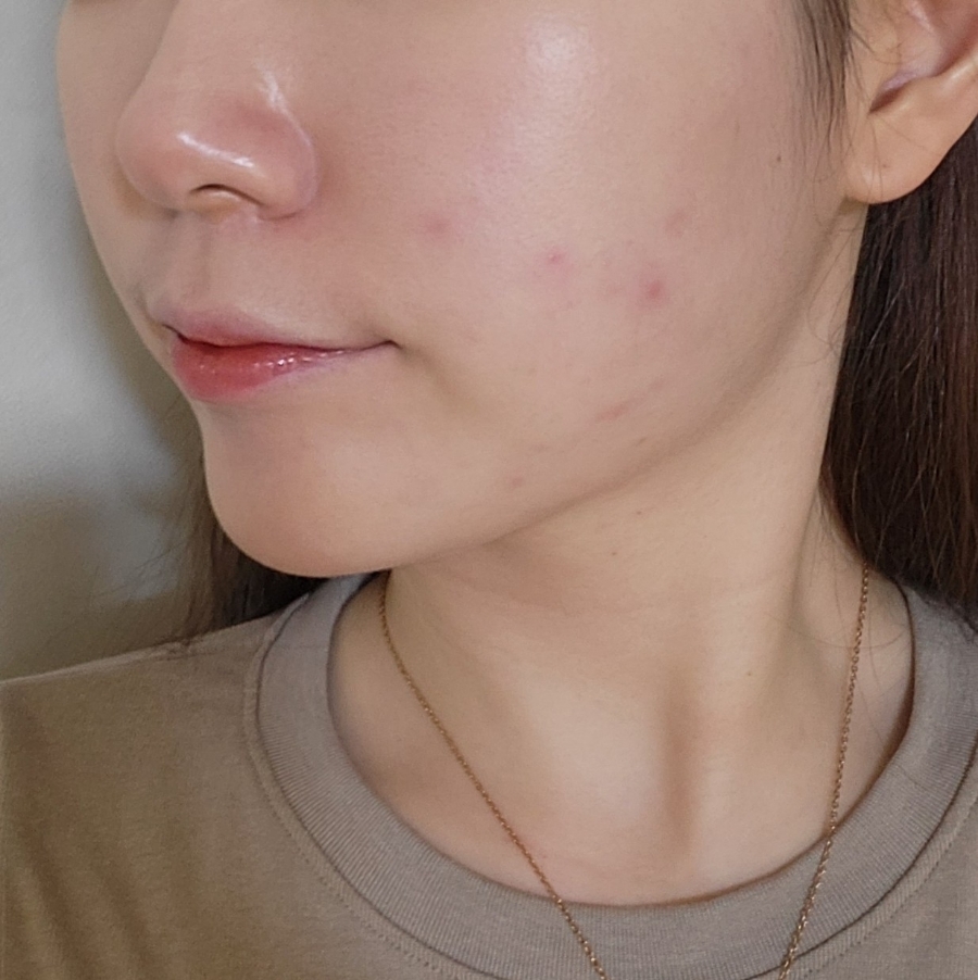 bbl 레이저 후기