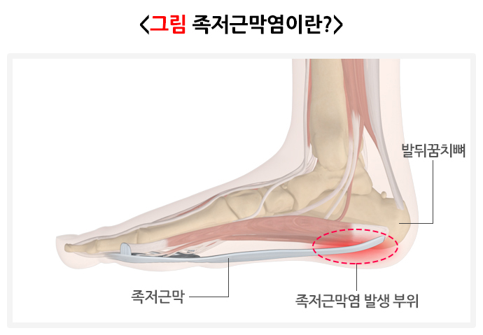 족저근막염이 뭘까요?