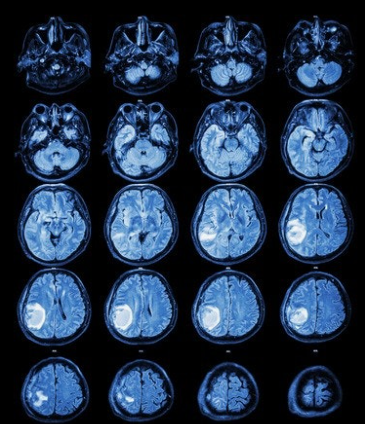 MRI촬영 관련 사진