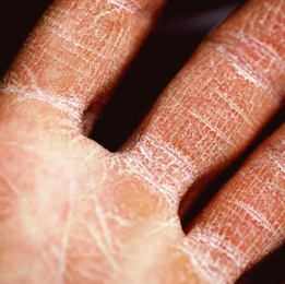 건조증 증상 피부 안구 코 구강 원인 치료법