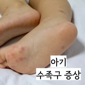 수족구병 증상과 예방 조치 방법 모음_19