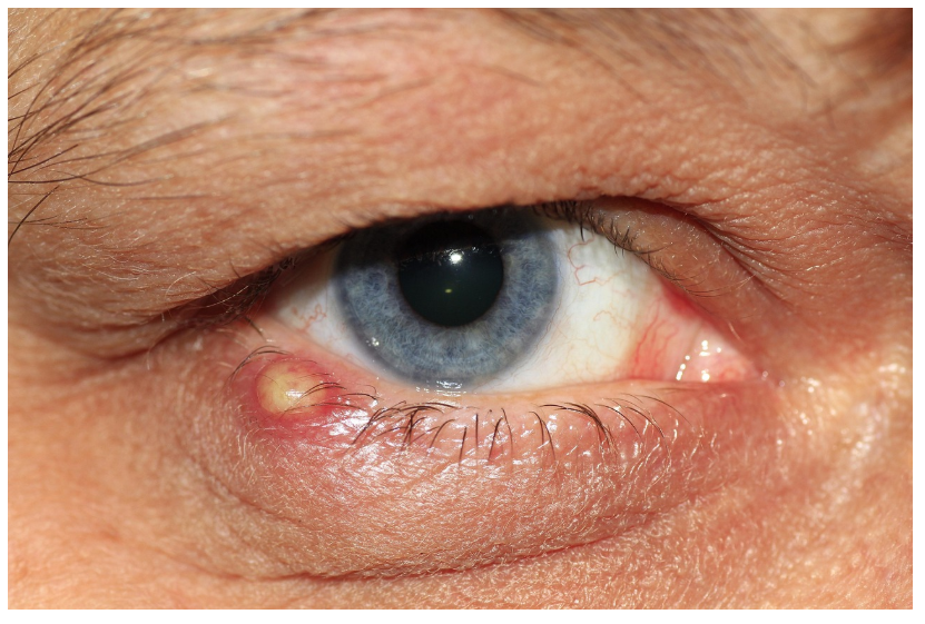 다래끼(맥립종), 단순한 눈병이 아닙니다! &ndash; 증상부터 치료&middot;예방까지 완전 정복