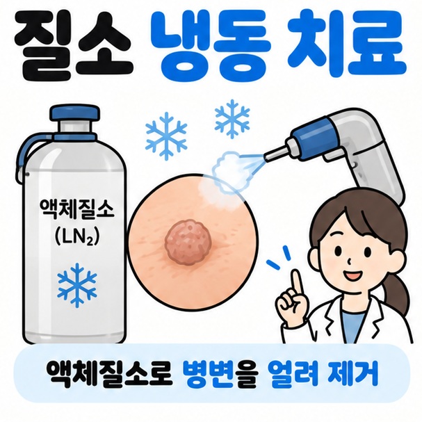액체질소 용기와 피부 병변 눈송이 아이콘을 중심으로 질소 냉동 치료 문구를 보여주는 차분한 피부과 카드뉴스 이미지