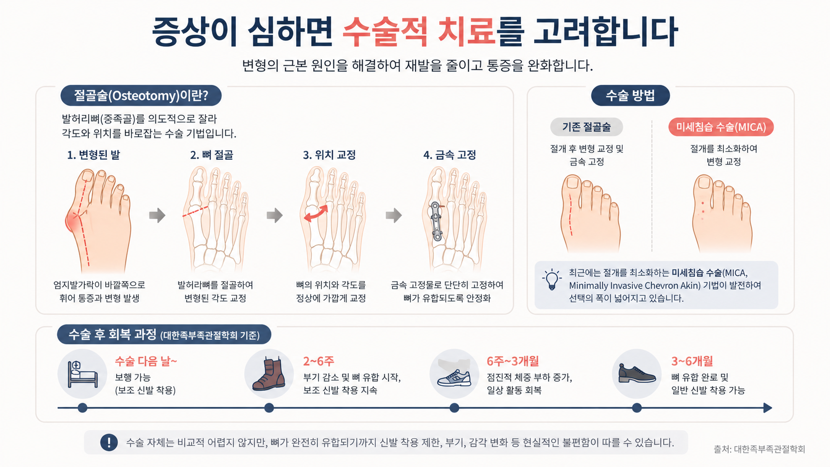 무지외반증 (발 변형, 신발 선택, 예방 관리)