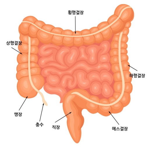 궤양성 대장염