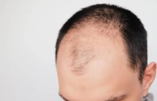 탈모유형