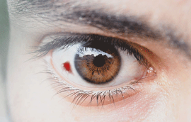 눈 실핏줄 터지는 이유 원인 결막하 출혈 자주 터지는 이유 치료방법