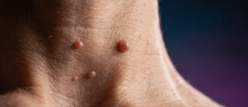 쥐젖 제거 방법