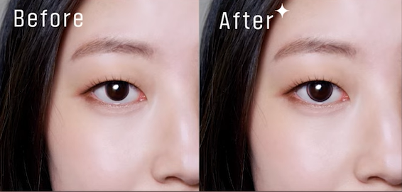 아이링 수술, 눈동자 성형, 아이링 수술 가격, 아이링 수술 부작용, 아이링 수술 후기, 아이링 수술 전후 사진, 아이링 수술 회복 기간, 서클렌즈 대체 성형, 눈동자 확대 수술