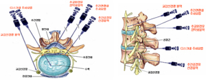 허리디스크 신경주사