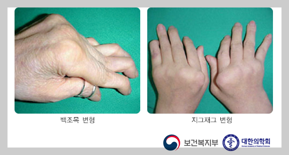 손가락 관절의 변형
