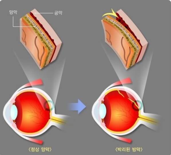 망막박리 및 망막열공을 그림으로 설명