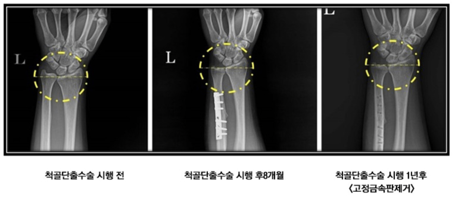 척골단축술-삼각섬유연골수술