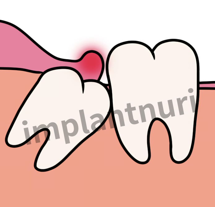 사랑니 발치 후 실밥 