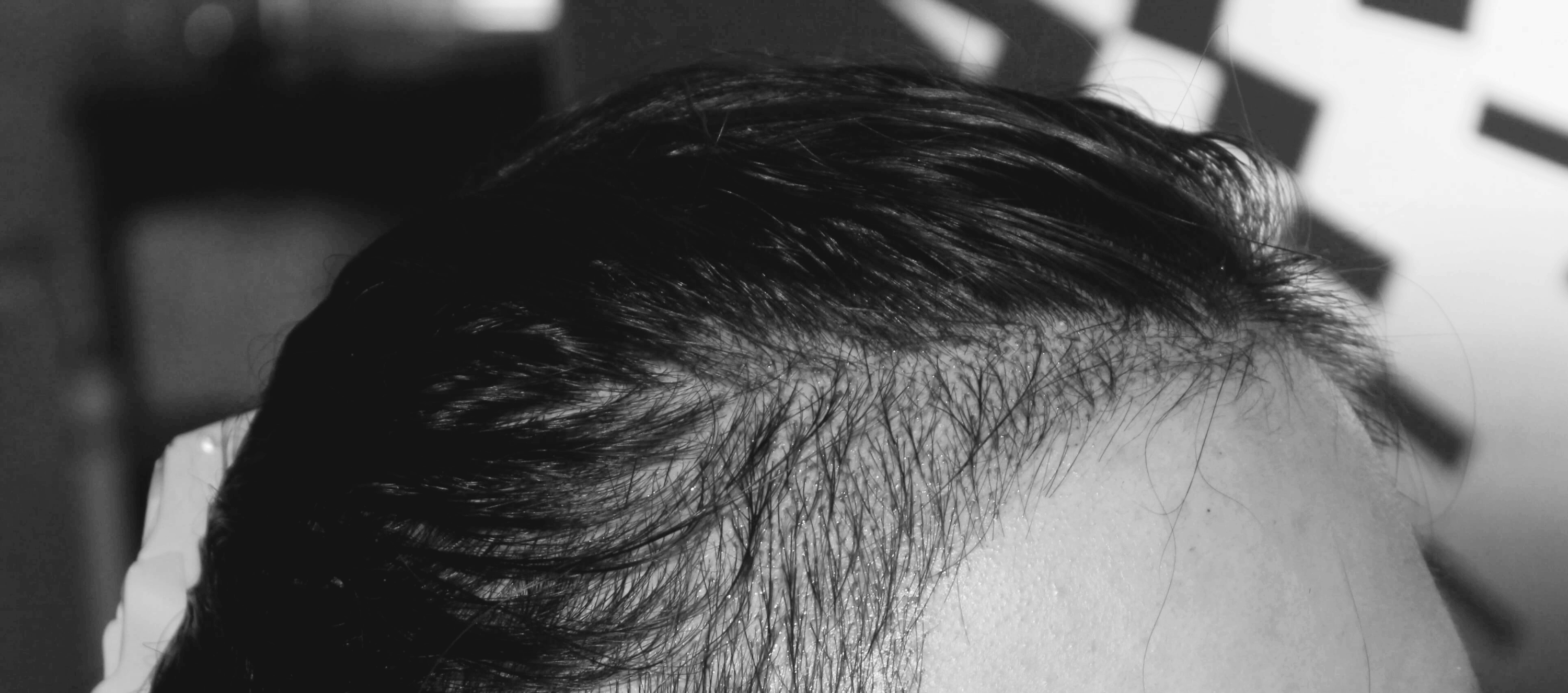 여자 헤어라인 수술 당일 직후