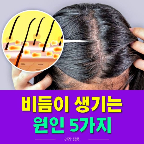 비듬이 생기는 원인 5가지 말레세지아 진균 곰팡이 증식, 건강 팁줌 매일꿀정보