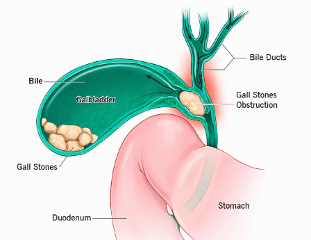 미리찌 증후군 (Mirizzi&amp;#39;s syndrom)