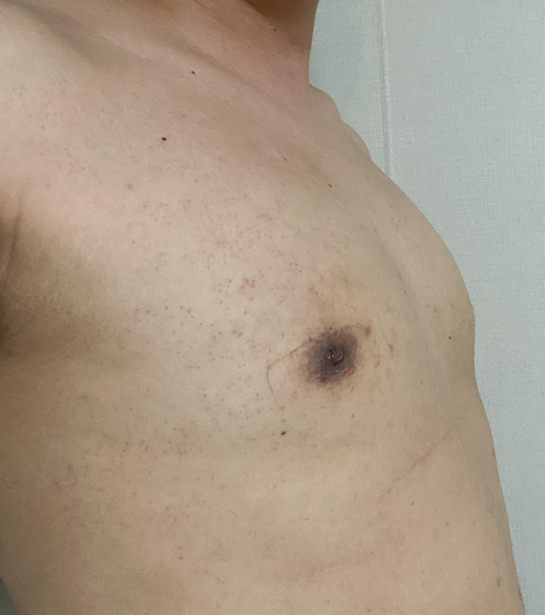 수술 2주 후 옆 모습