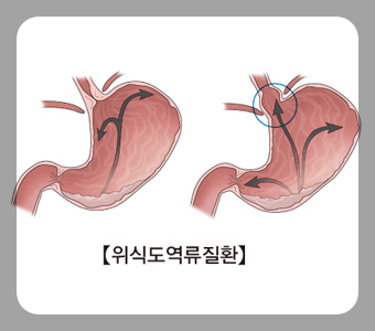 gastroesophageal reflux disease