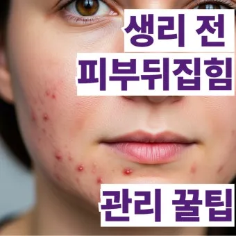 생리 전 뾰루지 폭발 원인과 해결법 7가지 생리 전후 뾰루지 발생 이유 완벽 분석_12