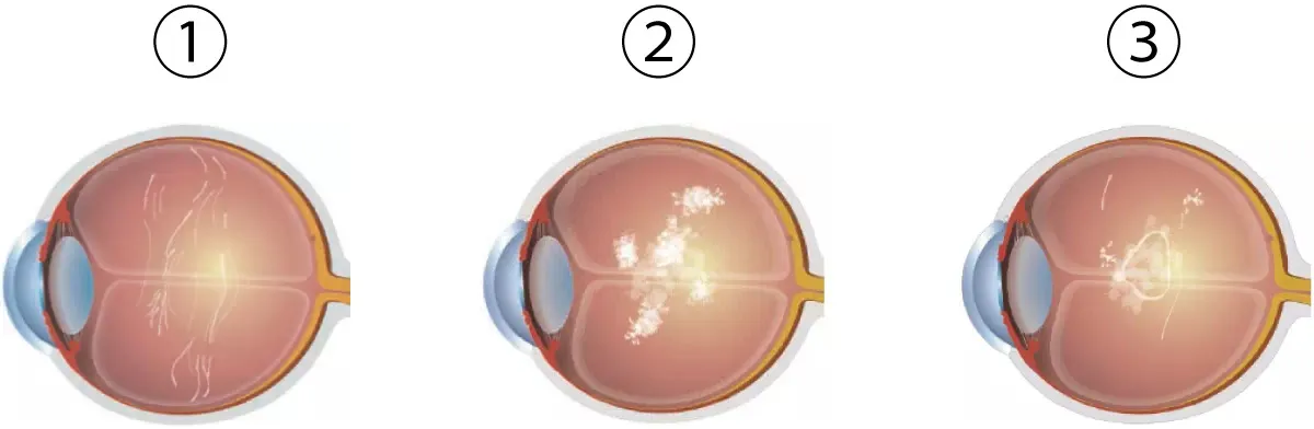 비문증-원인-날파리증- 광시증-왜-생기는-걸까?-비문증-자연치유-부터-치료-방법까지-확인하기