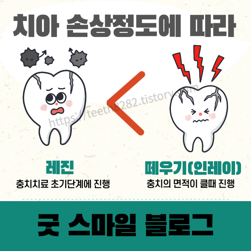 레진-인레이-차이점