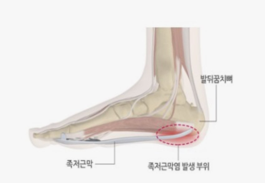 발바닥 통증의 원인,치료법의 관한 사진