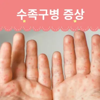 수족구병 증상과 예방 조치 방법 모음_5