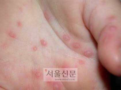 수족구병