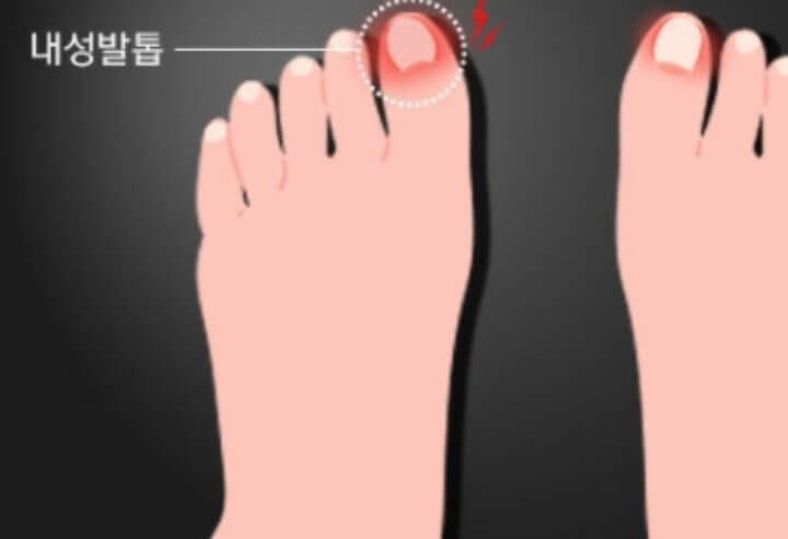 내성발톱 생기는 이유
