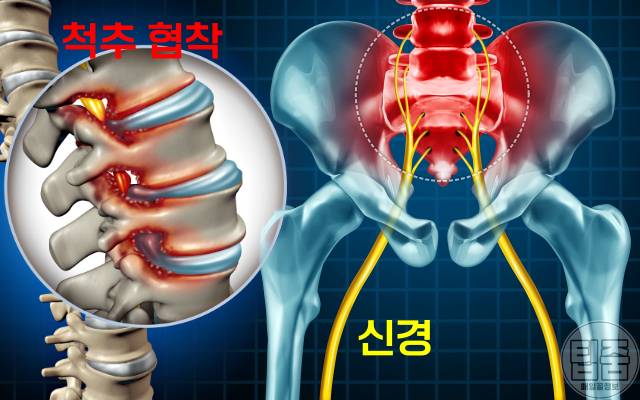종아리 통증 원인 종아리가 땡기고 아파요 척추협착증
