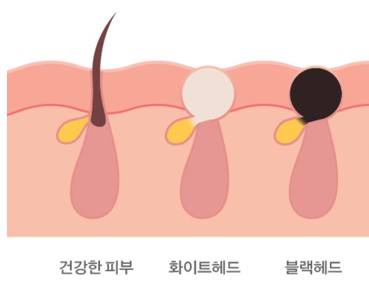 블랙헤드와 화이트헤드의 차이